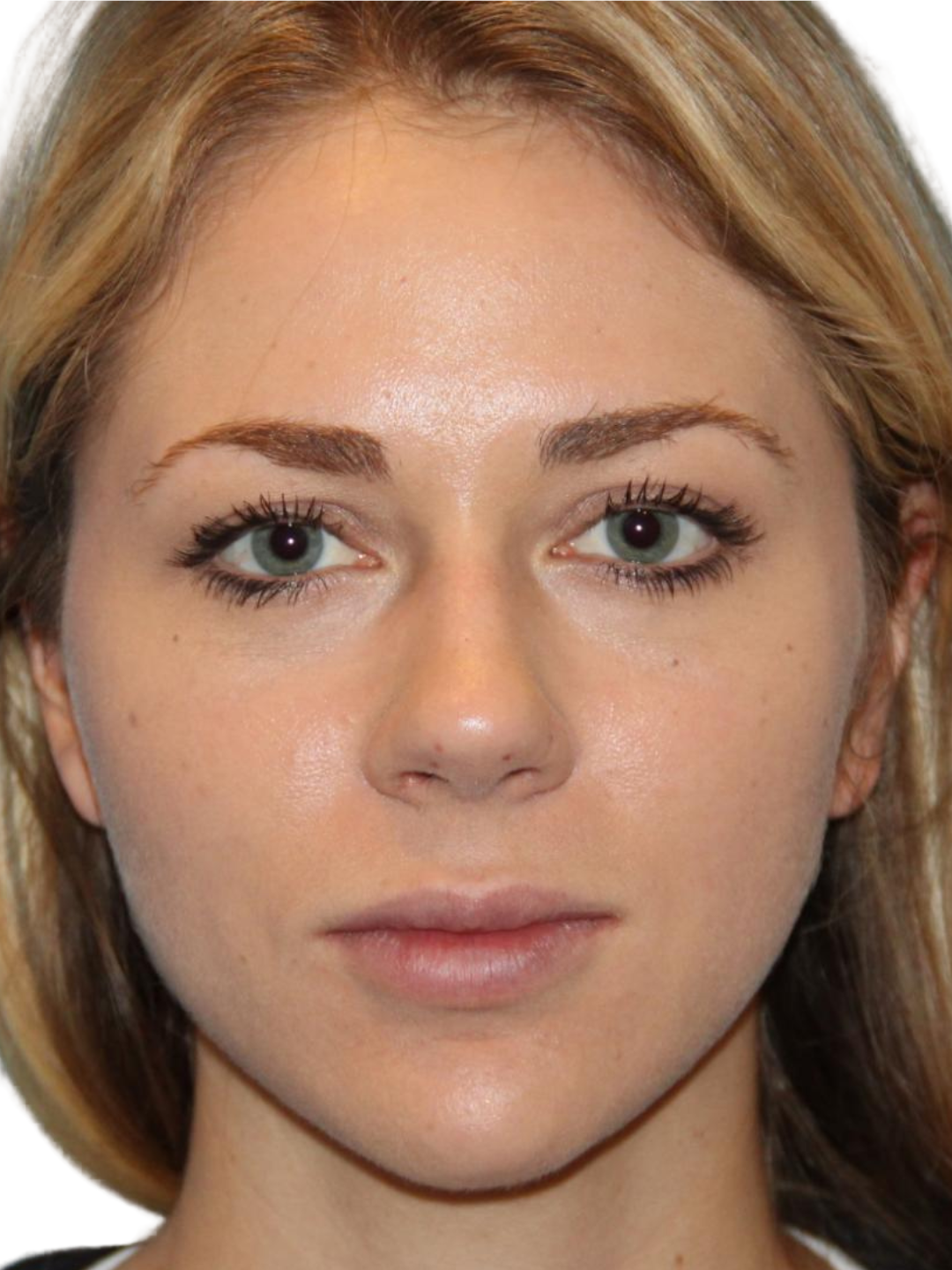 Chin & jawline — after treatment