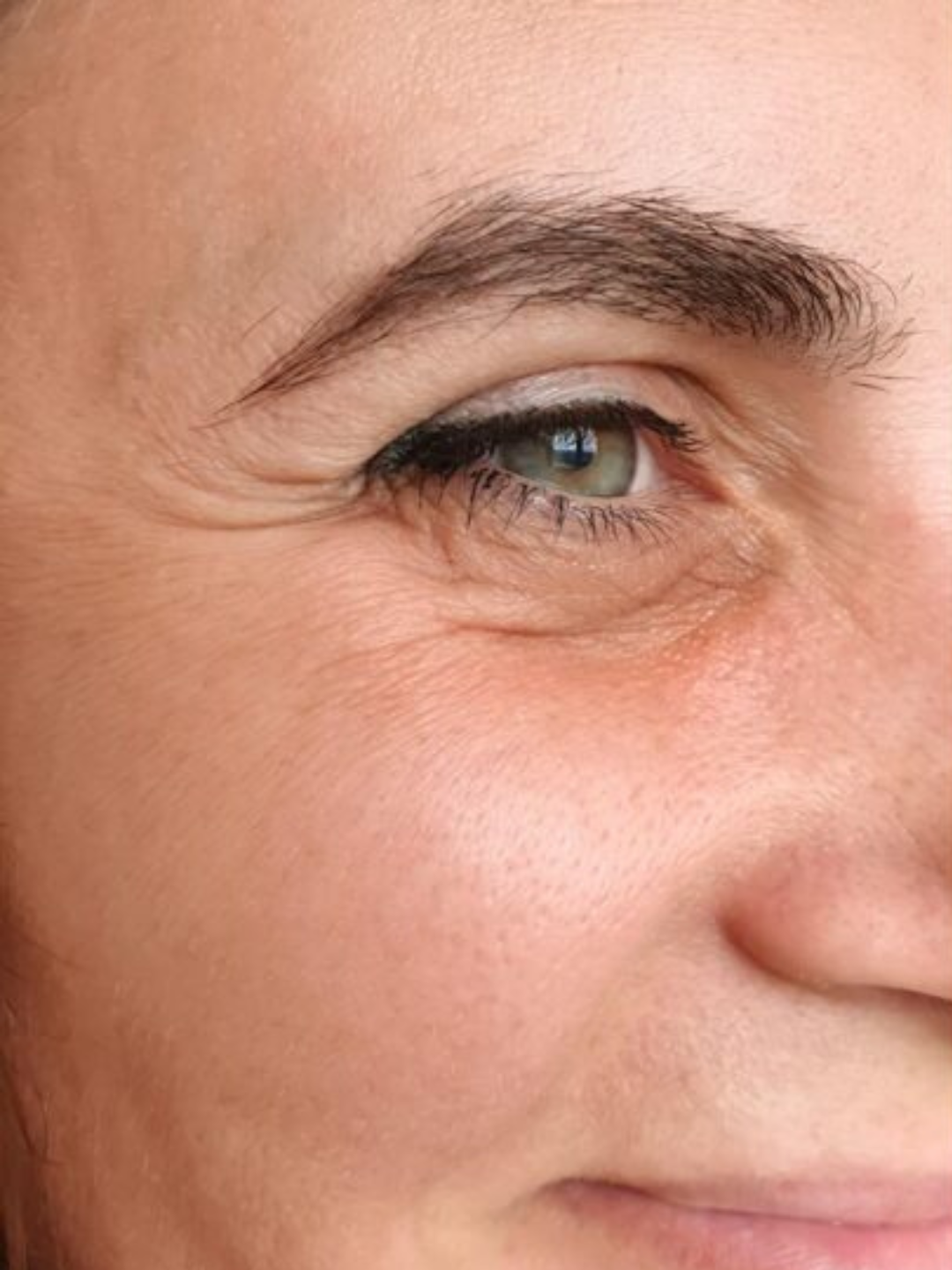 Crow's feet — before treatment