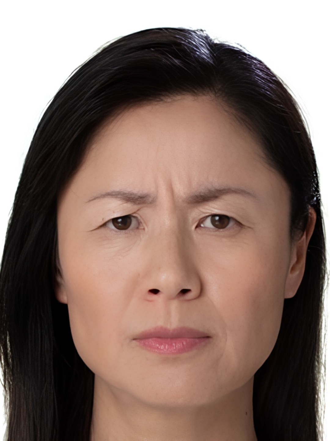 Frown lines (11s) — before treatment