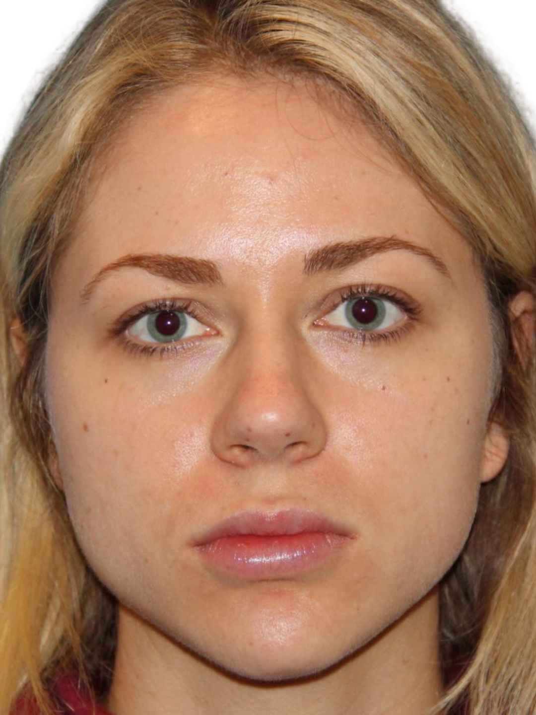 Chin & jawline — before treatment