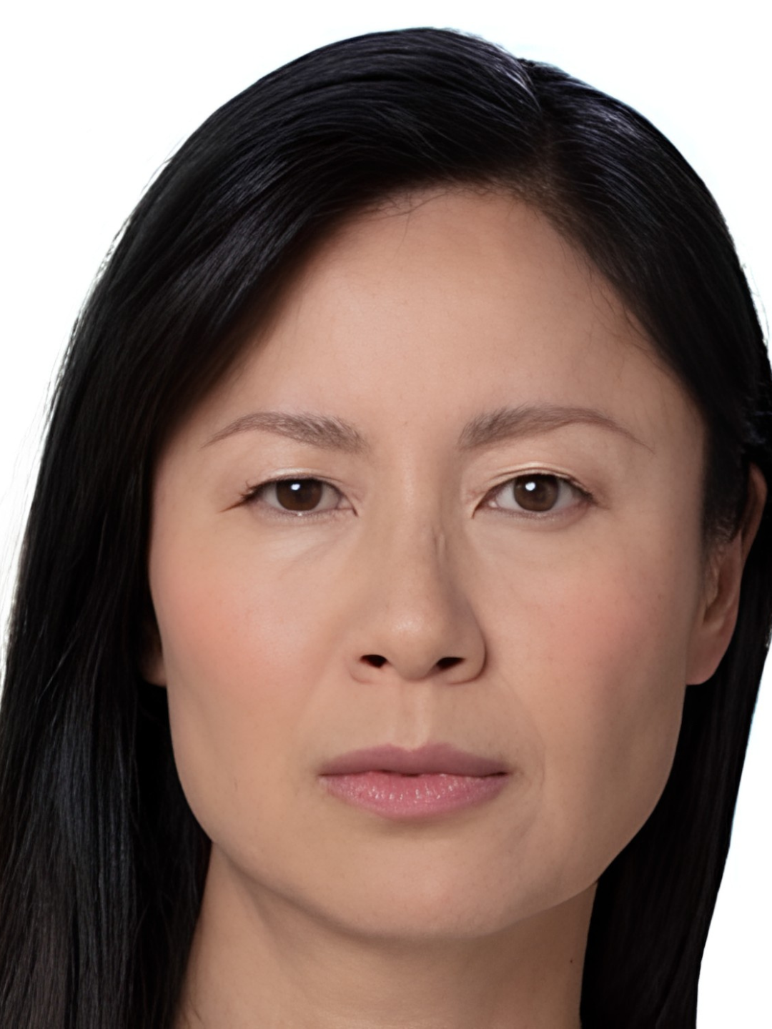 Frown lines (11s) — after treatment