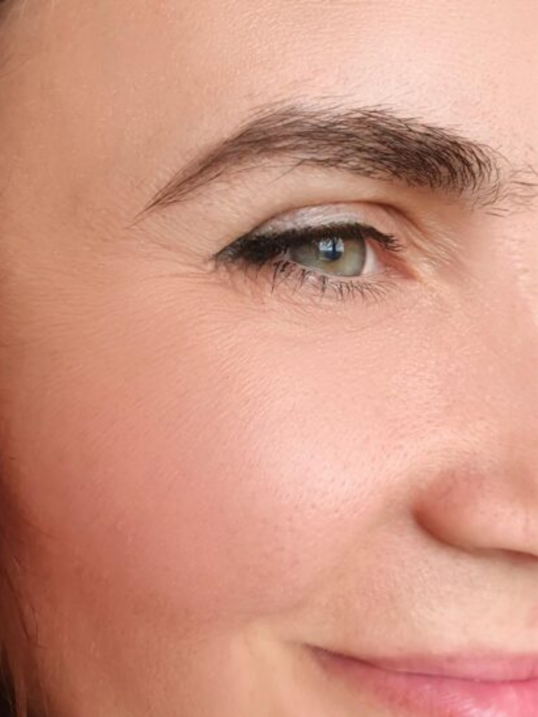 Crow's feet — after treatment